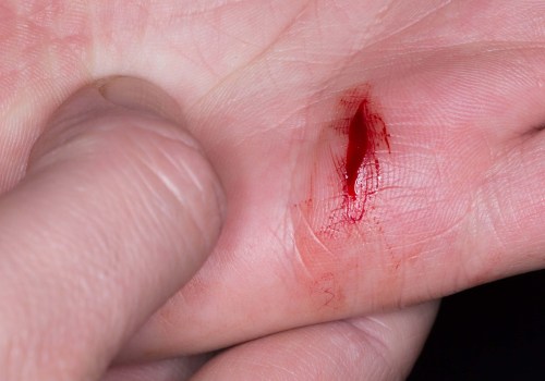 Expert Tips for Proper Wound Drainage and Healing