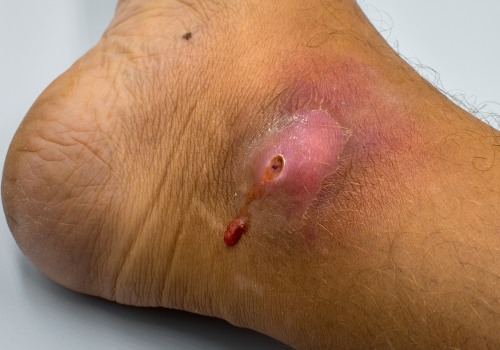 Expert Tips for Treating Purulent Wounds